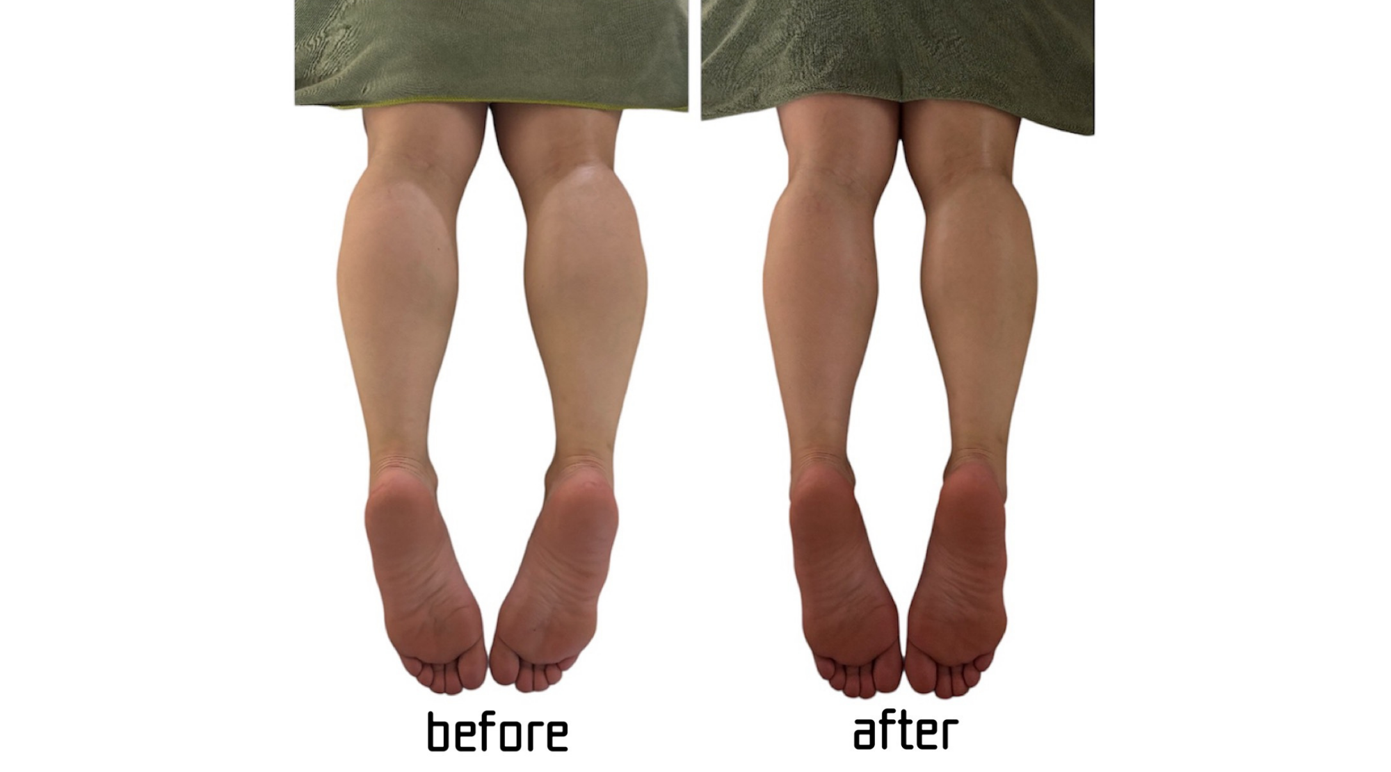 吉川市 NR機器導入 美脚ケア